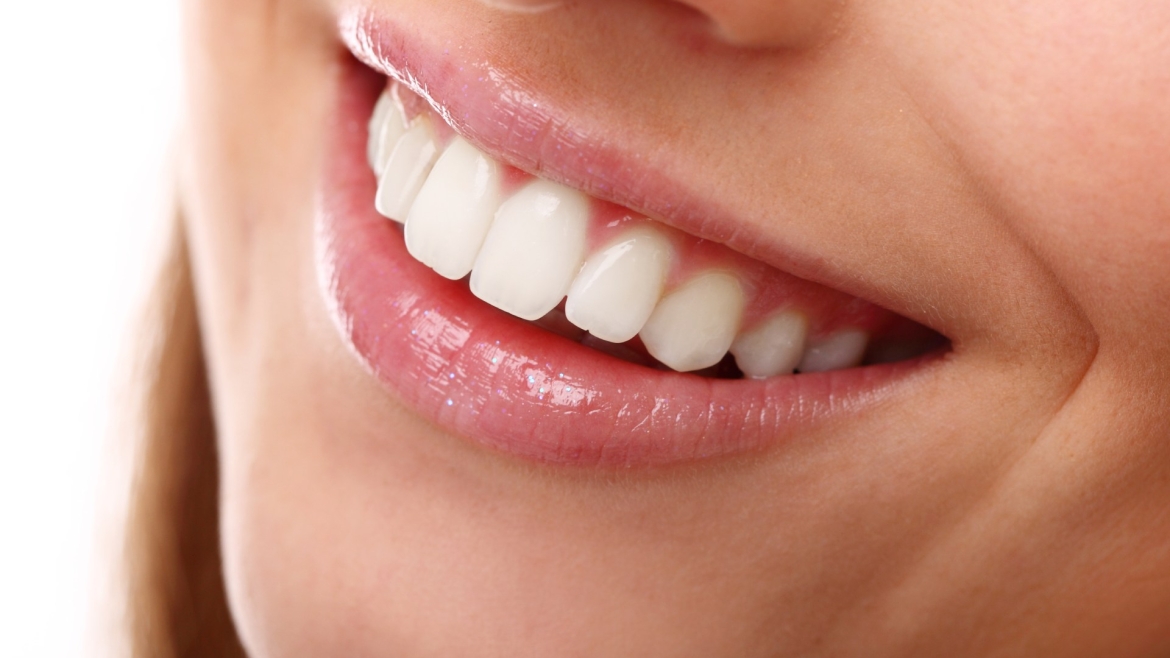 Sbiancamenti domiciliari e alla poltrona